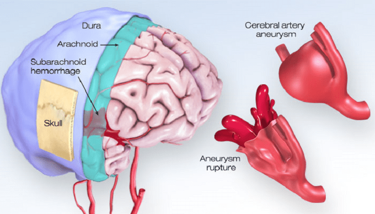 Aneurysm Brain Treatment